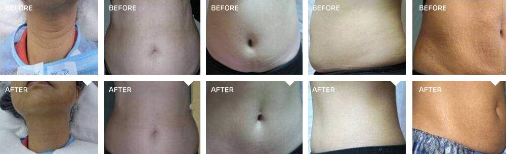 Skin Tightening in new jersey