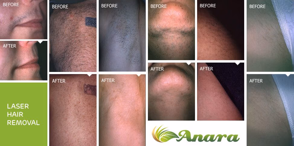 Permanent Laser Hair Reduction in New Jersey Permanent Laser Hair Reduction in New Jersey