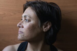 Chemical Peel Professionals at Anara Medspa