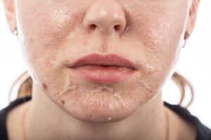 Chemical Peels Treatment in East Brunswick, NJ