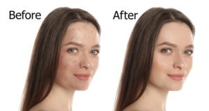 Chemical Peels (Before and After )