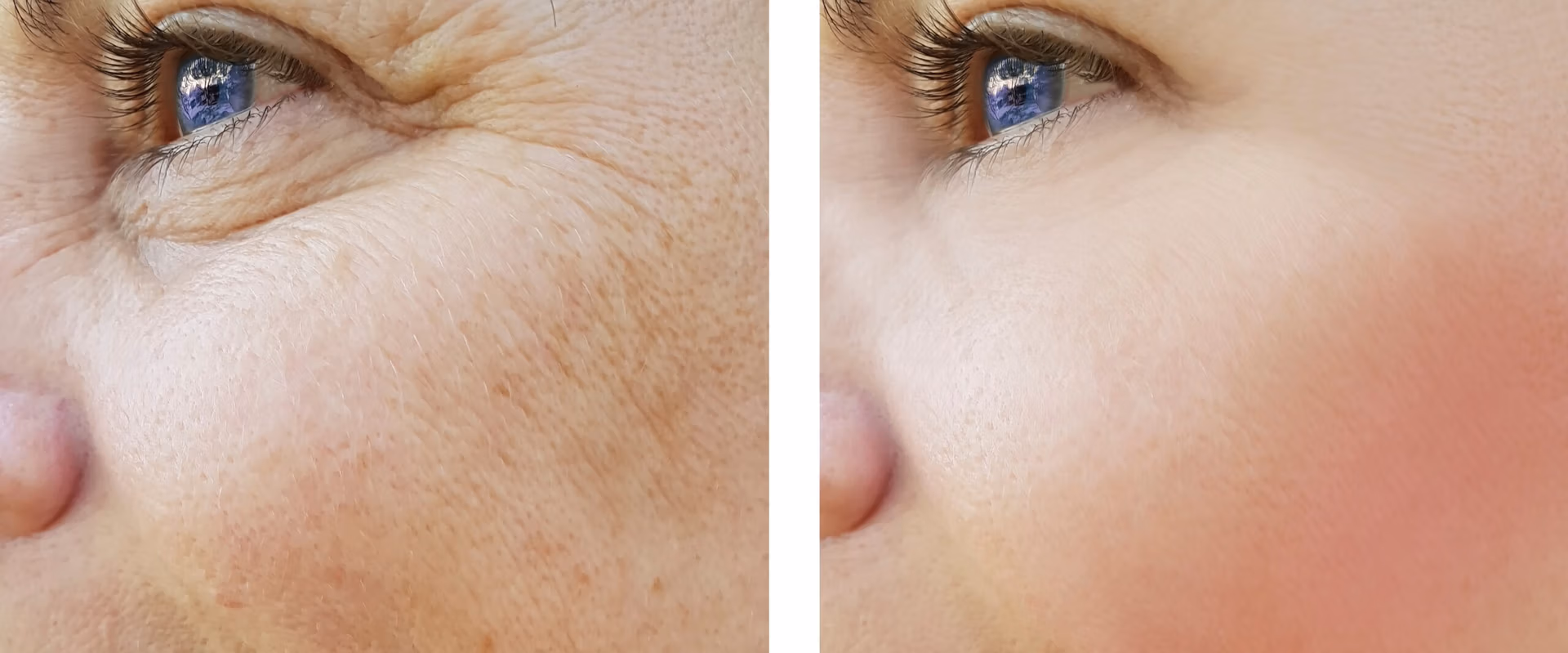IPL Photofacial laser treatment in New Jersey IPL Photofacial laser treatment in New Jersey