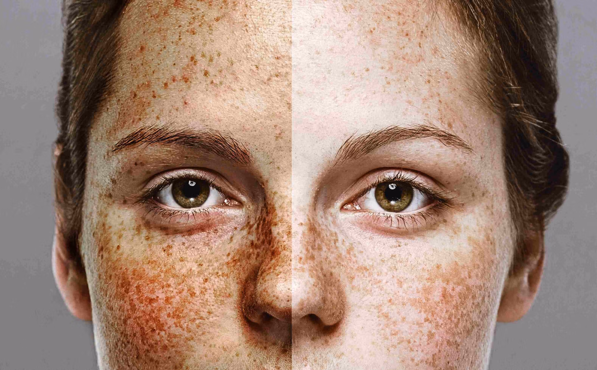 IPL Photorejuvenation Brown Spots IPL Photorejuvenation Brown Spots