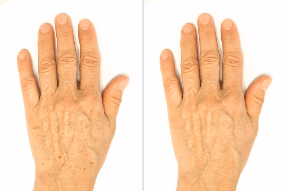 Age,Spots,On,The,Hands,Before,And,After,Removal,Using Hand rejuvenation treatment East Brunswick NJ