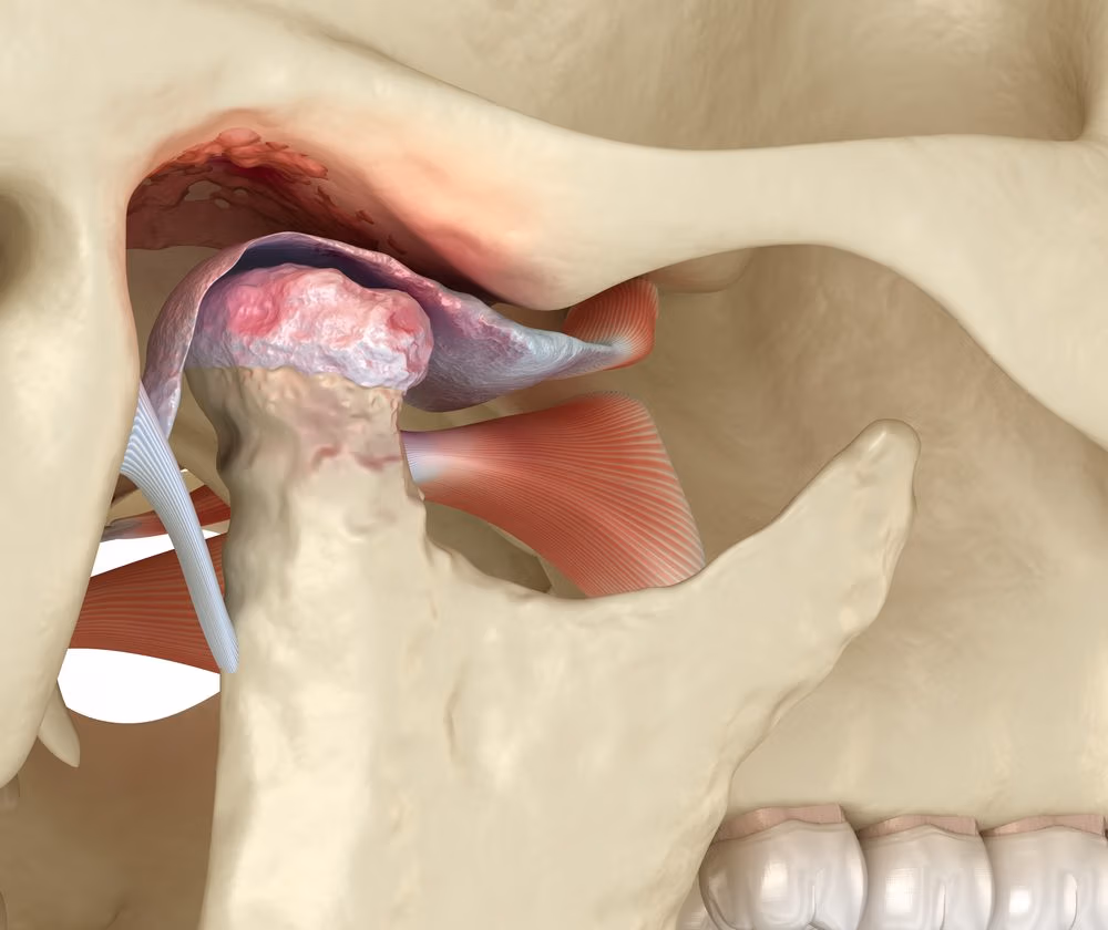 Botox for TMJ Pain Anatomy of how Botox for TMJ Pain relates