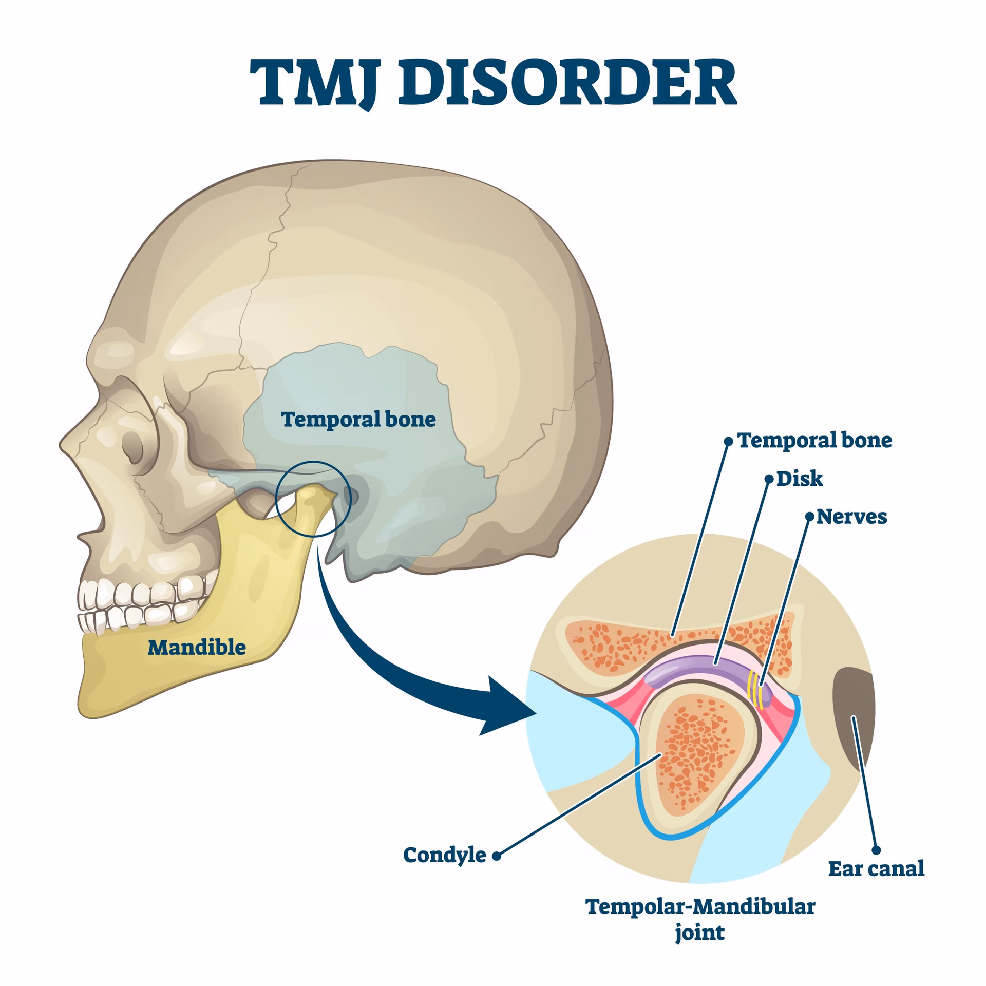 Botox for TMJ Pain in New Jersey Botox for TMJ Pain in New Jersey