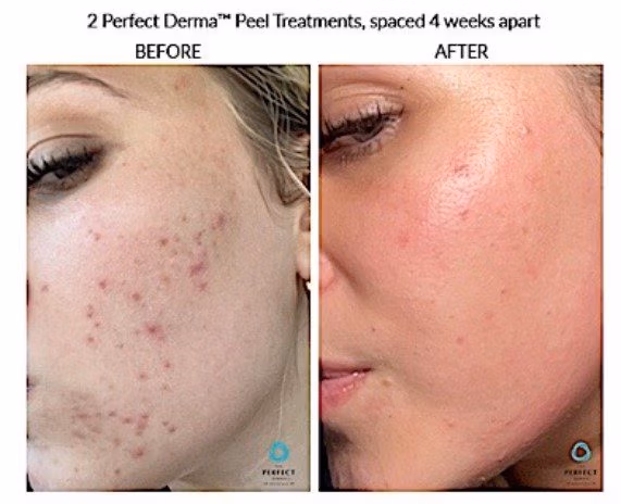 improvement in acne in the face of a woman after perfect derma peel before – after