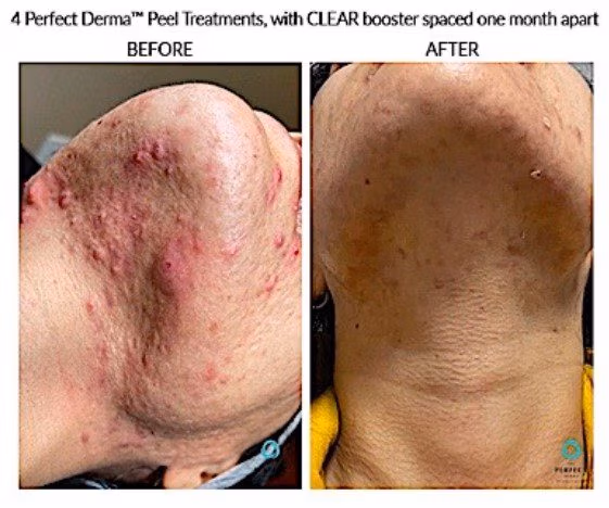severe acne improved with four perfect derma peels in the jawline
