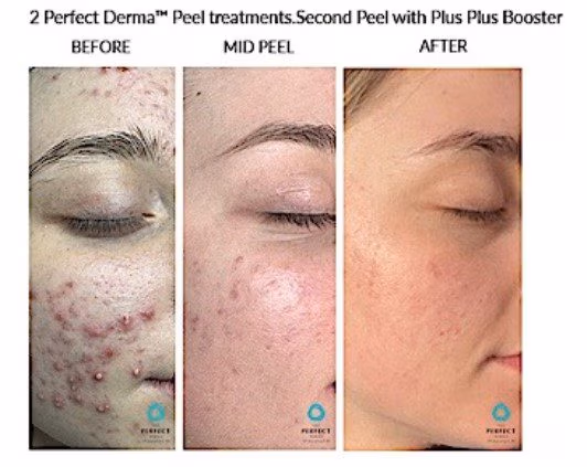acne improved with two perfect derma peels in a woman