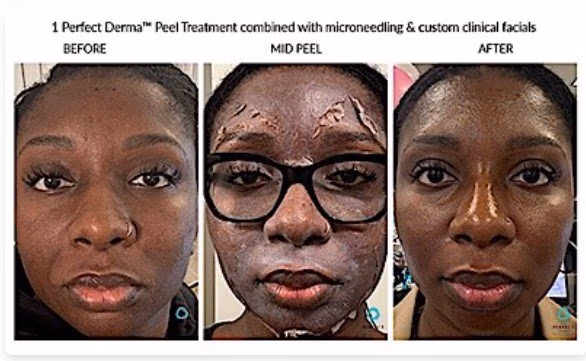 Perfect Derma Peel Before After in a dark skin