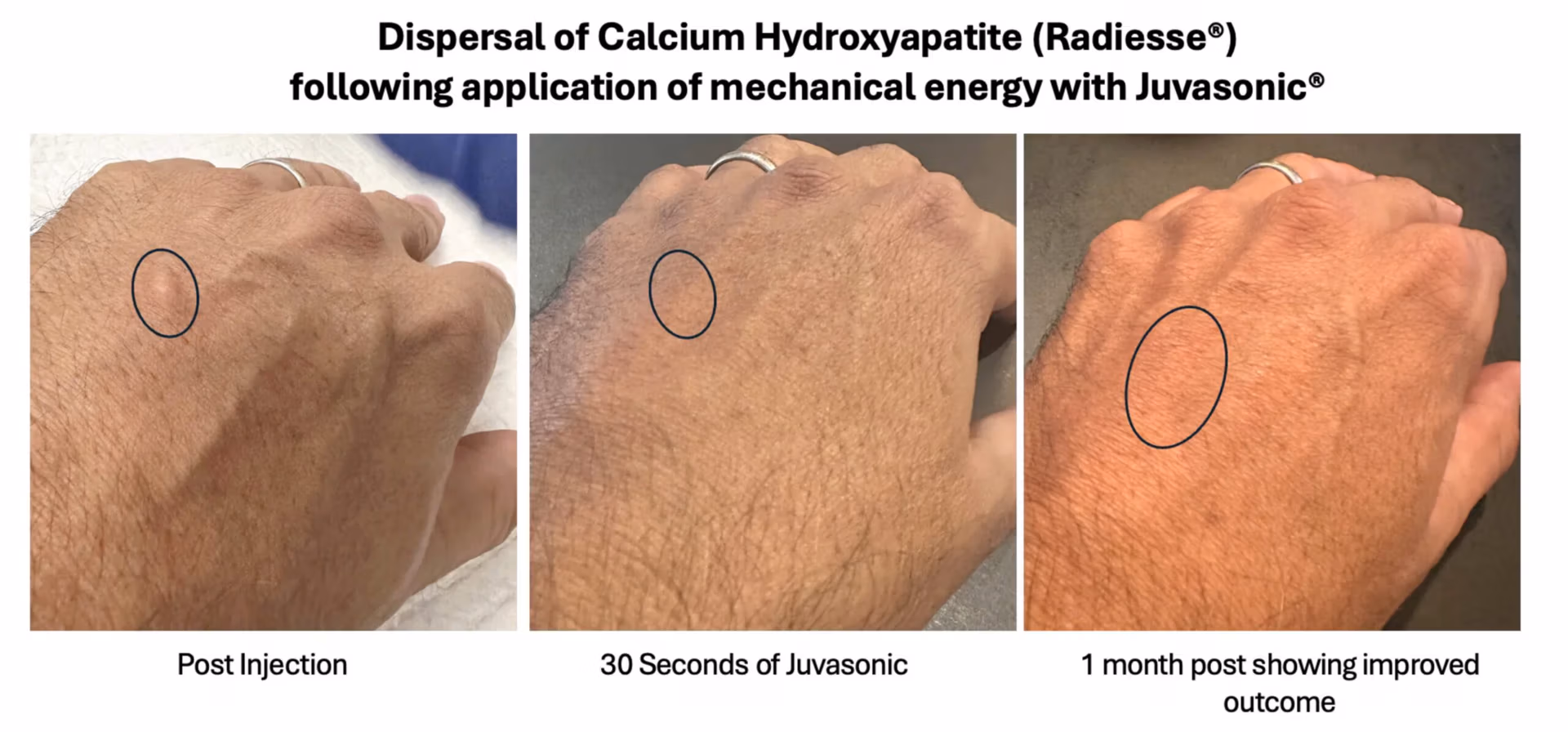 CAHA_page-0001 Dispersal of Radiuses with Juvasonic