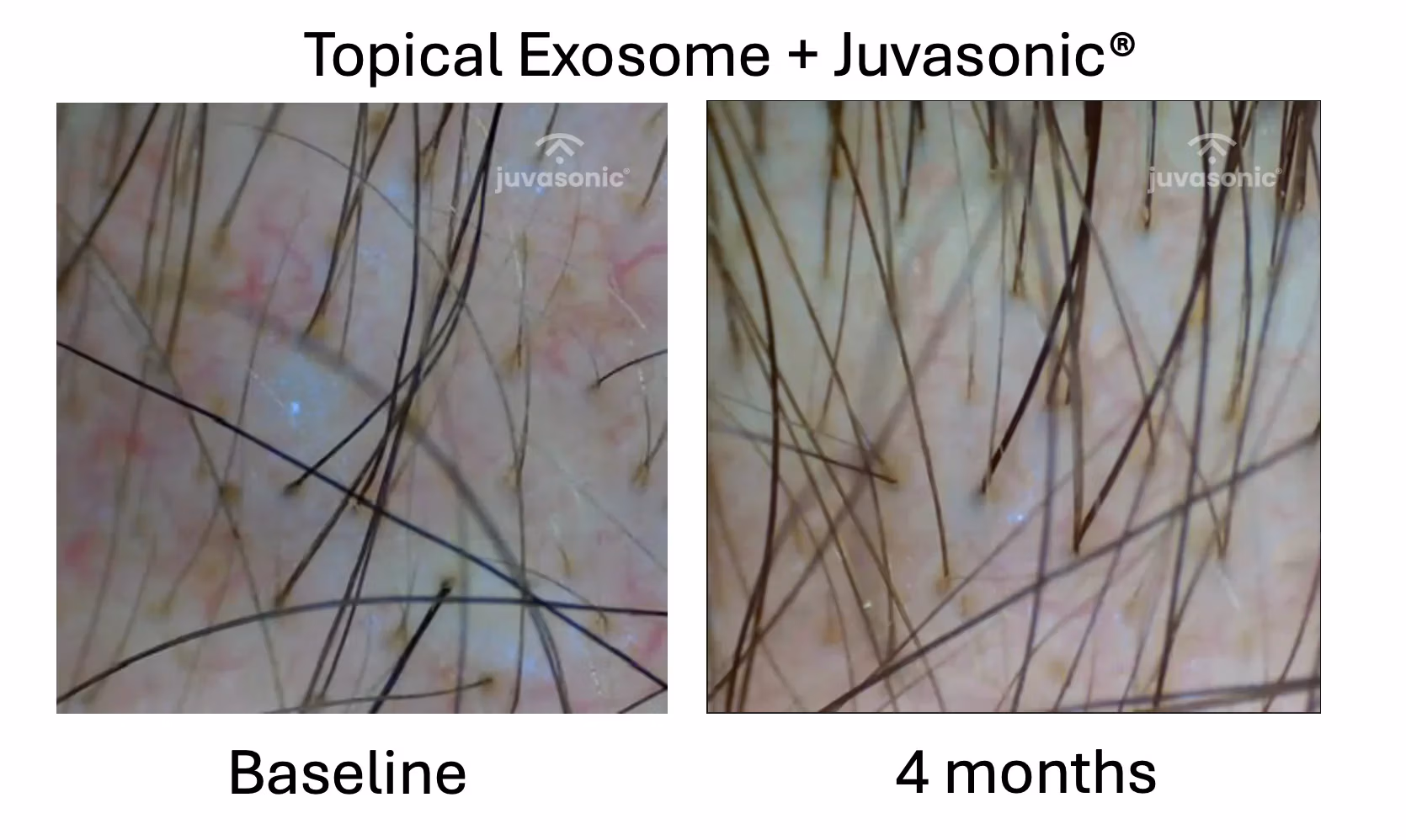 Topical_Exosome_Juvasonic Topical_Exosome_Juvasonic