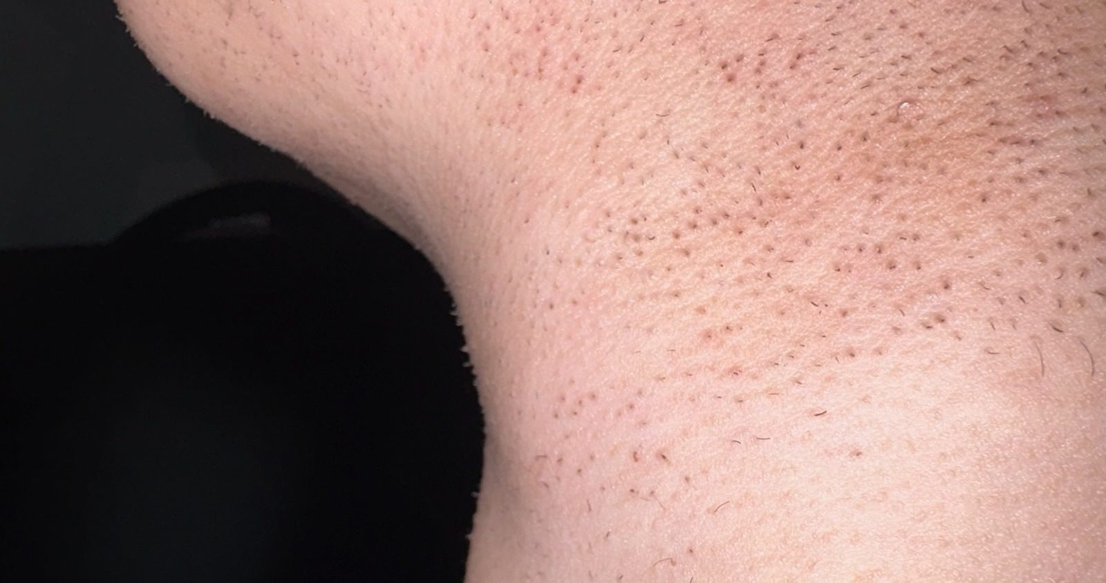 Lser Hair Removal